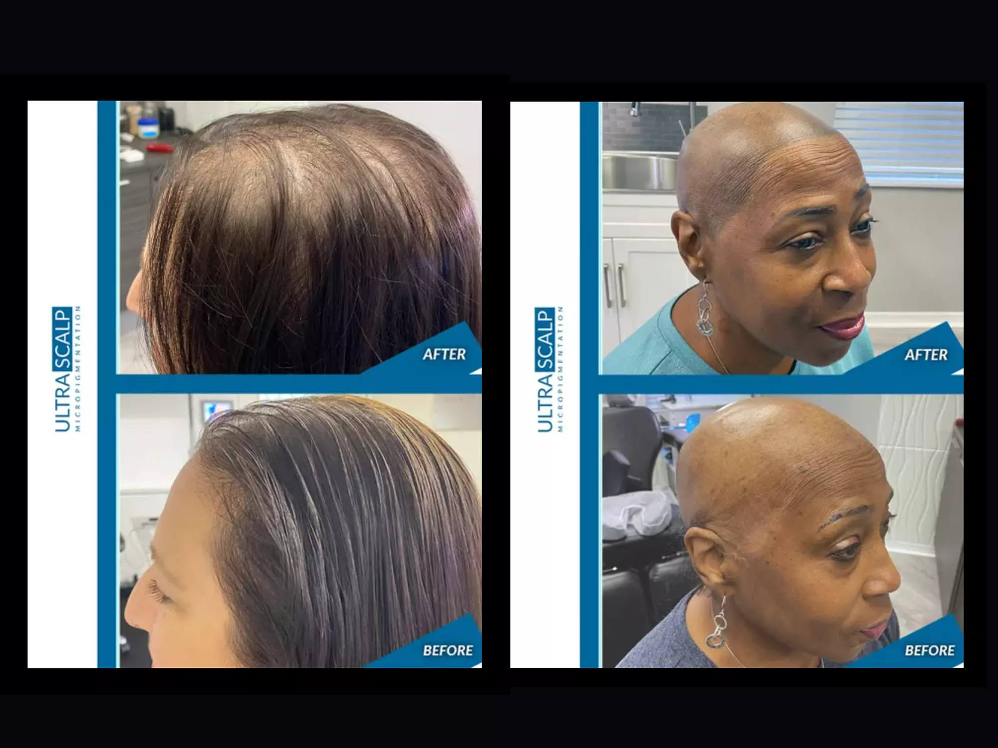 Up to 20% Off on Salon - Scalp Care at Ultra Scalp Micropigmentation - Primary Image