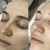 Image 2: Up to 70% Off on Facials at Euphoria Aesthetics