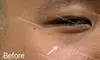 Up to 71% Off on Vampire Facelift at One Beauty Aesthetics