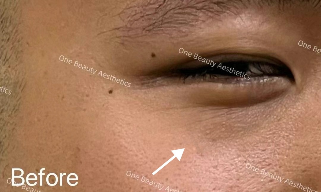 Up to 71% Off on Vampire Facelift at One Beauty Aesthetics