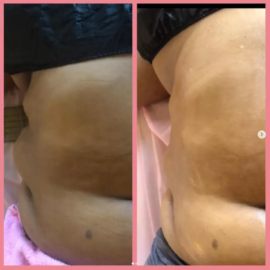 Up to 14% Off Non-Invasive Lipo at Bodied By Simone Llc - Second Medium