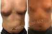 Up to 51% Off on Lymphatic Drainage Massage at Shaped Beautifully - Second Medium