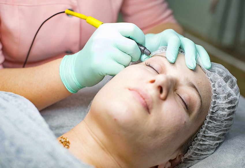 One 15- or 30-Minute Electrolysis Session or Three 15-Minute Sessions