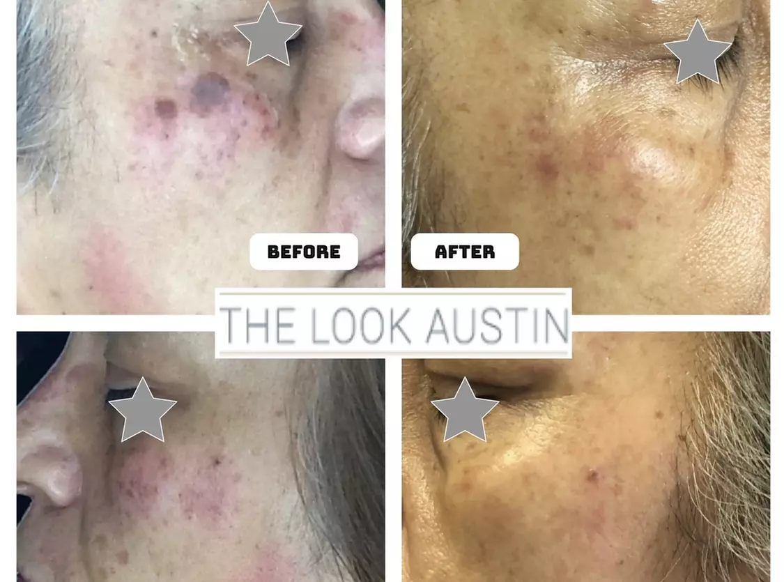 $200.00 for Microneedling with IPL Photofacial at The Look Austin ($400.00 Value) - Second Medium
