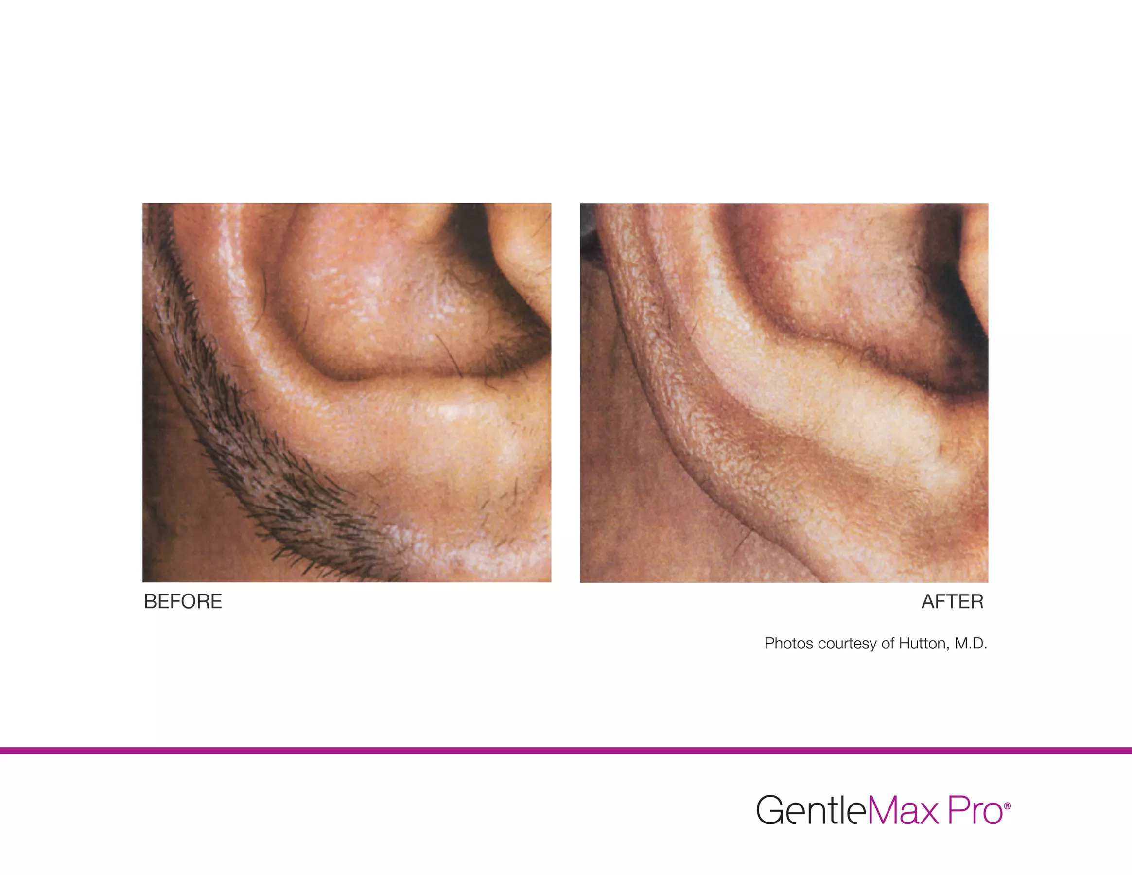 Up to 48% Off on Spa / Salon Beauty Treatments at Metamorphosis - Second Medium