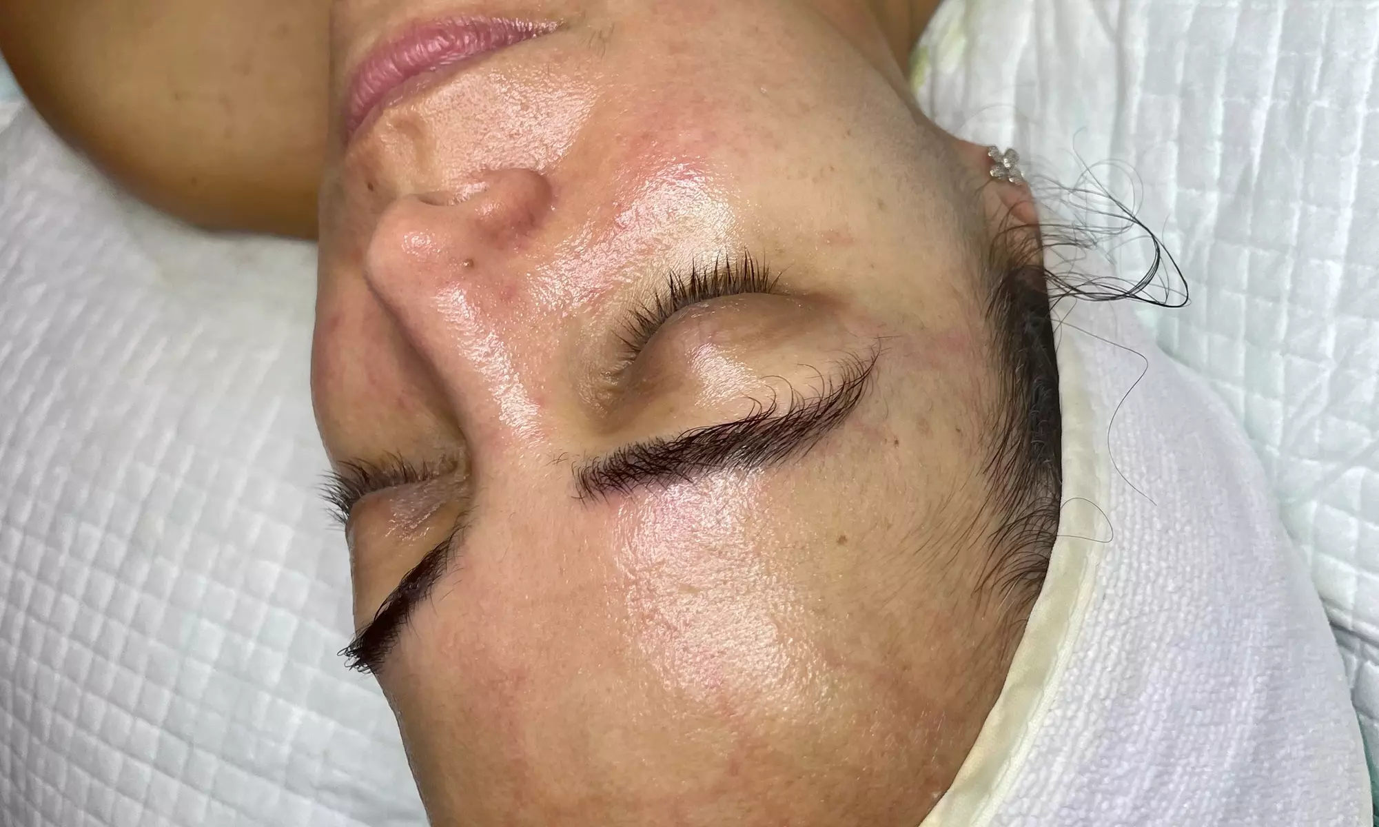 Rejuvenate Your Skin with Microdermabrasion Treatment