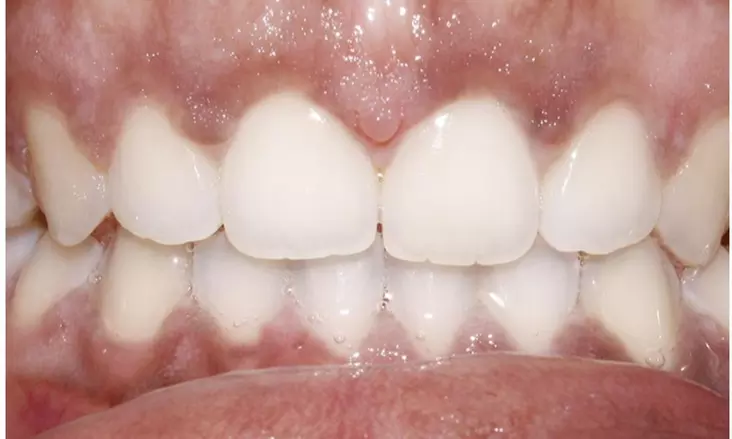 Up to 98% Off on Invisalign at Boynton Plaza Dentistry - Second Medium
