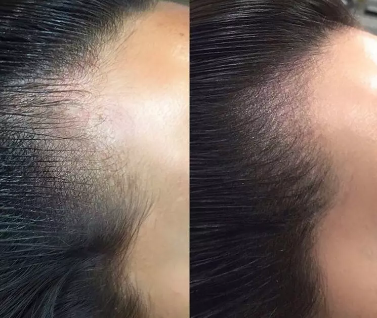 Up to 46% Off on Hair Restoration - Non-Surgical at Brows By Von - Primary Image