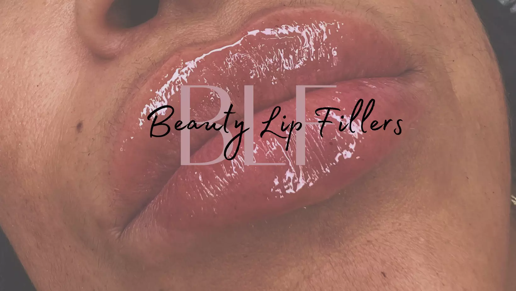 Up to 10% Off on Injection - Hyaluronic Acid at Beauty Lip Fillers - Primary Image