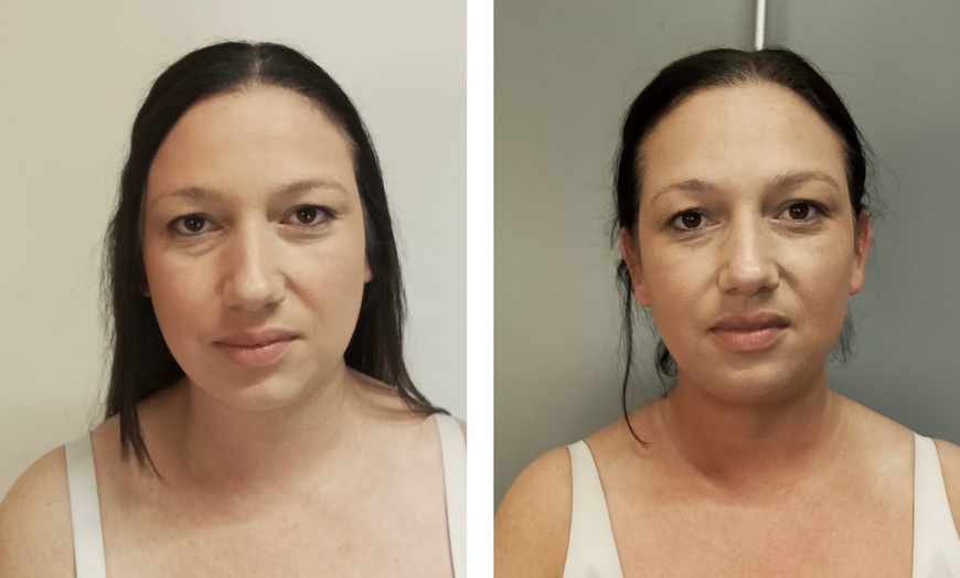 Image 1: Up to 62% Off on Facelift - Non-Surgical at Your Sculpt Studio