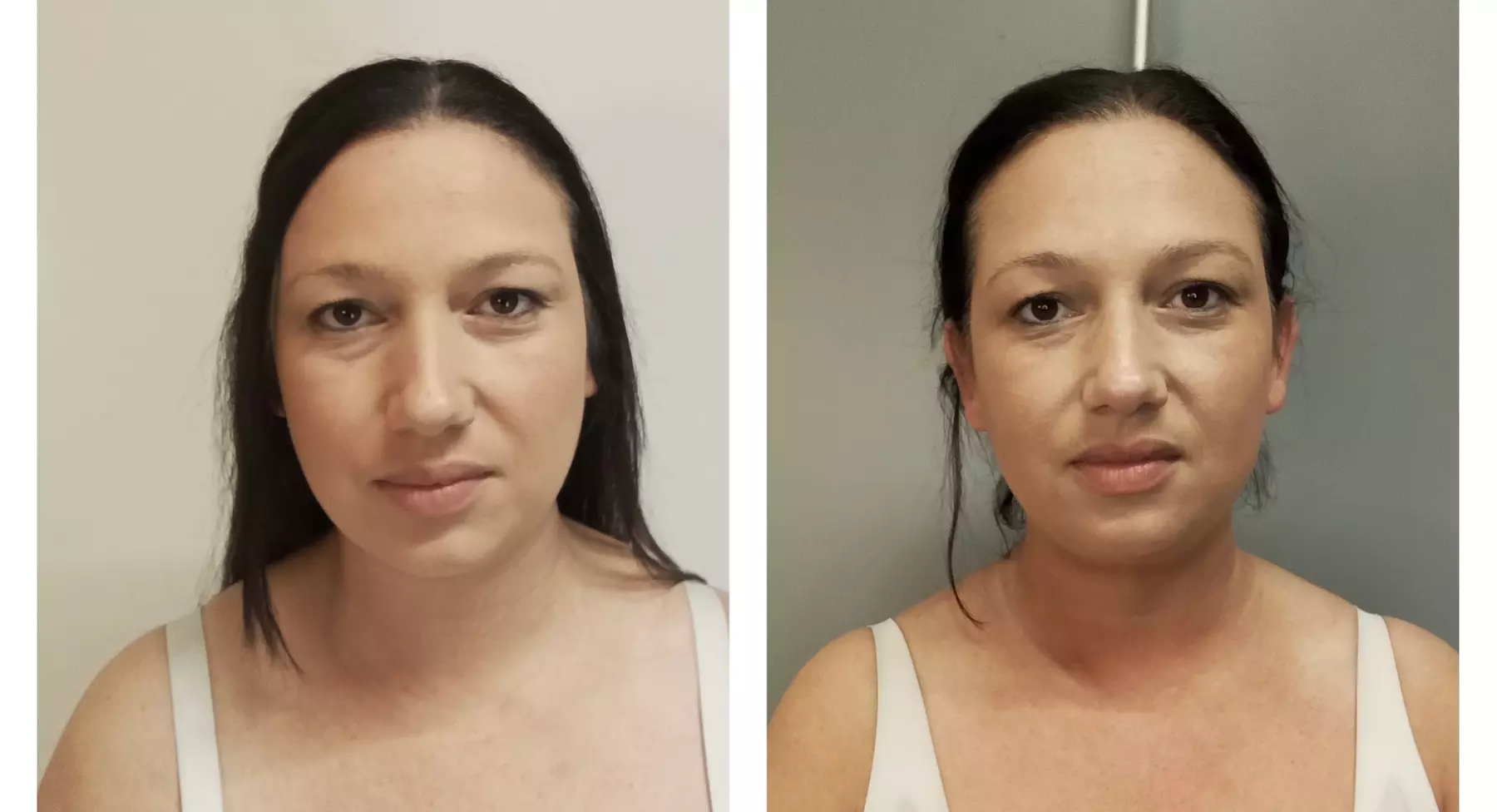 Up to 62% Off on Facelift - Non-Surgical at Your Sculpt Studio