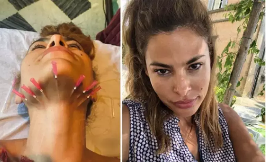 Celebrity-Coveted Cheek Pop or Snatched Jawline with PDO Threads