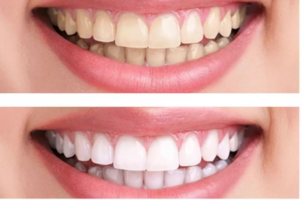 Up to 31% Off on Teeth Whitening at House of Beauty Austin - Primary Image