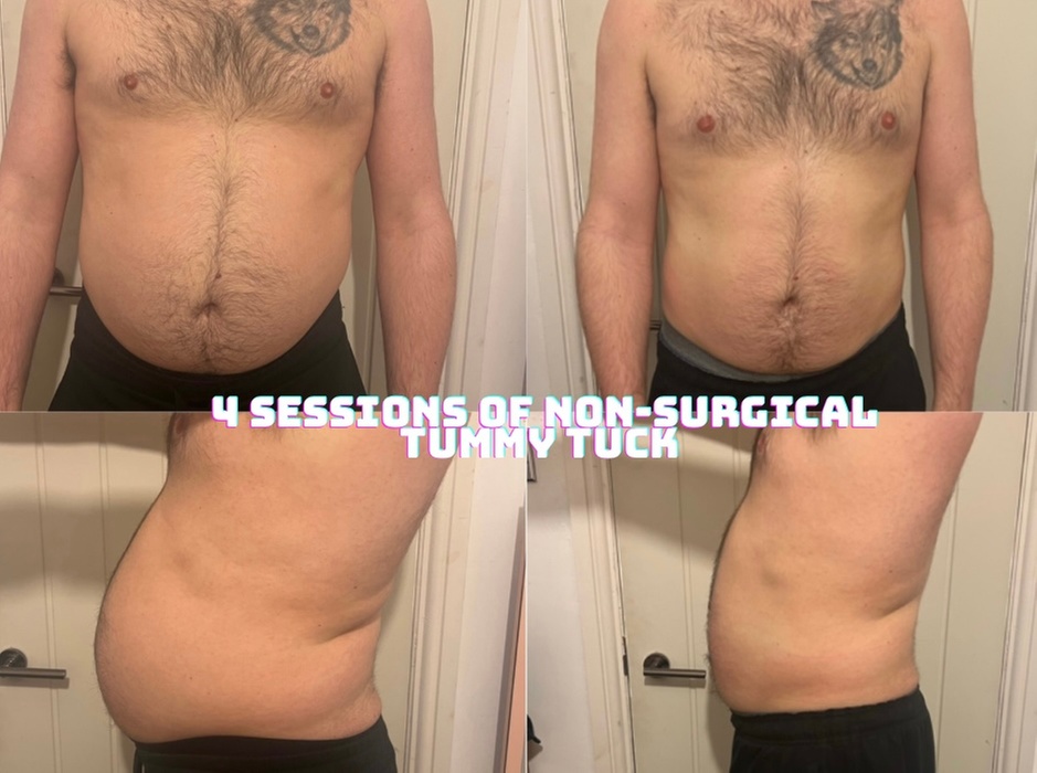 Up to 57% Off on Ultrasonic Fat Reduction