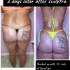 Image 1: Lift and tone with nonsurgical butt cupping sessions
