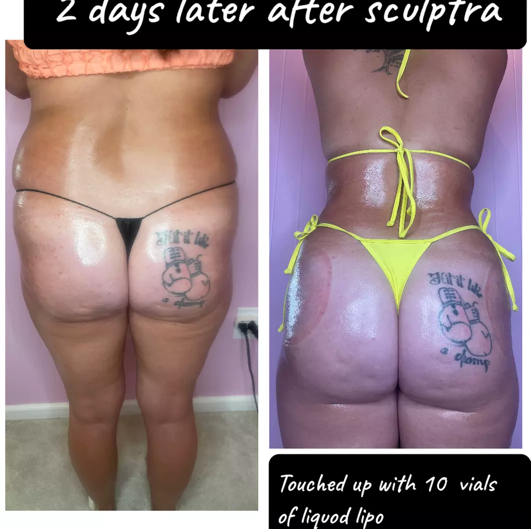 Lift and tone with nonsurgical butt cupping sessions