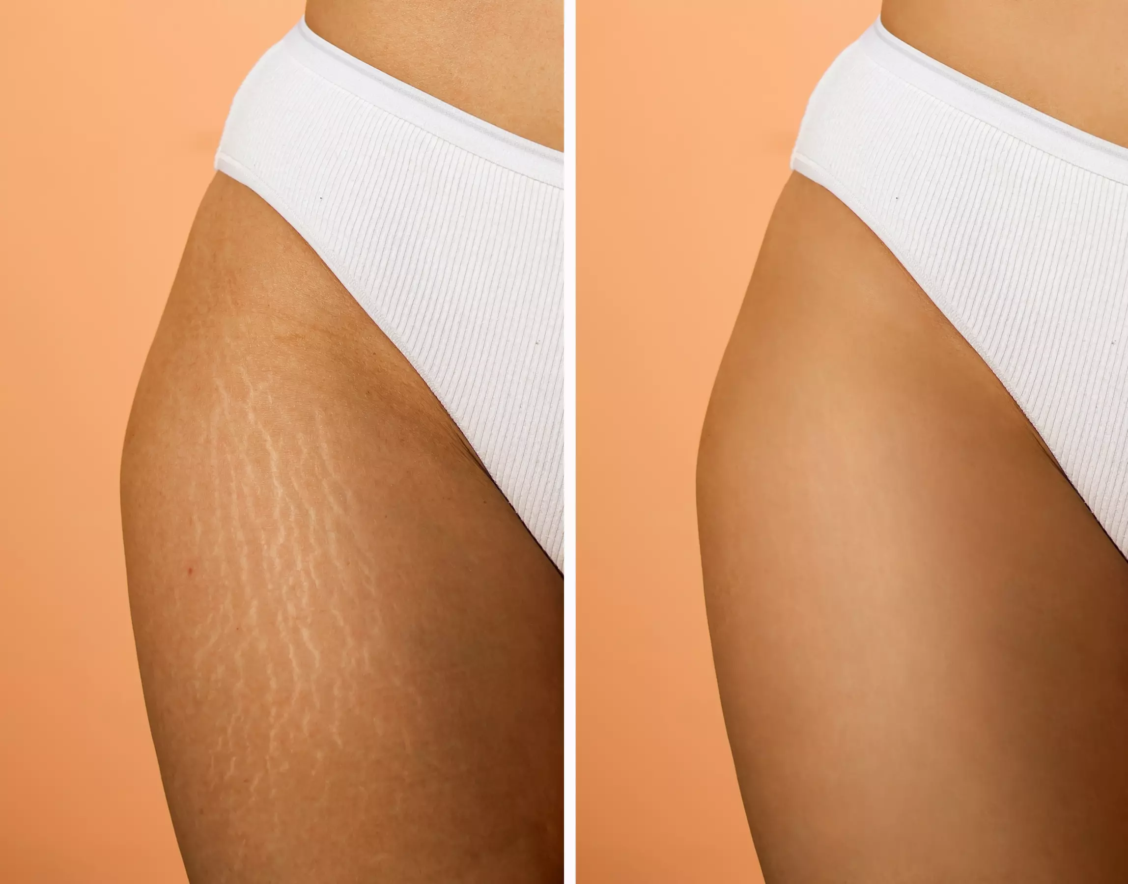 Experience BeautyCamo's Tattoo Sessions with Inkless Stretch Mark and Scar Camouflage up to 60% off - Primary Image