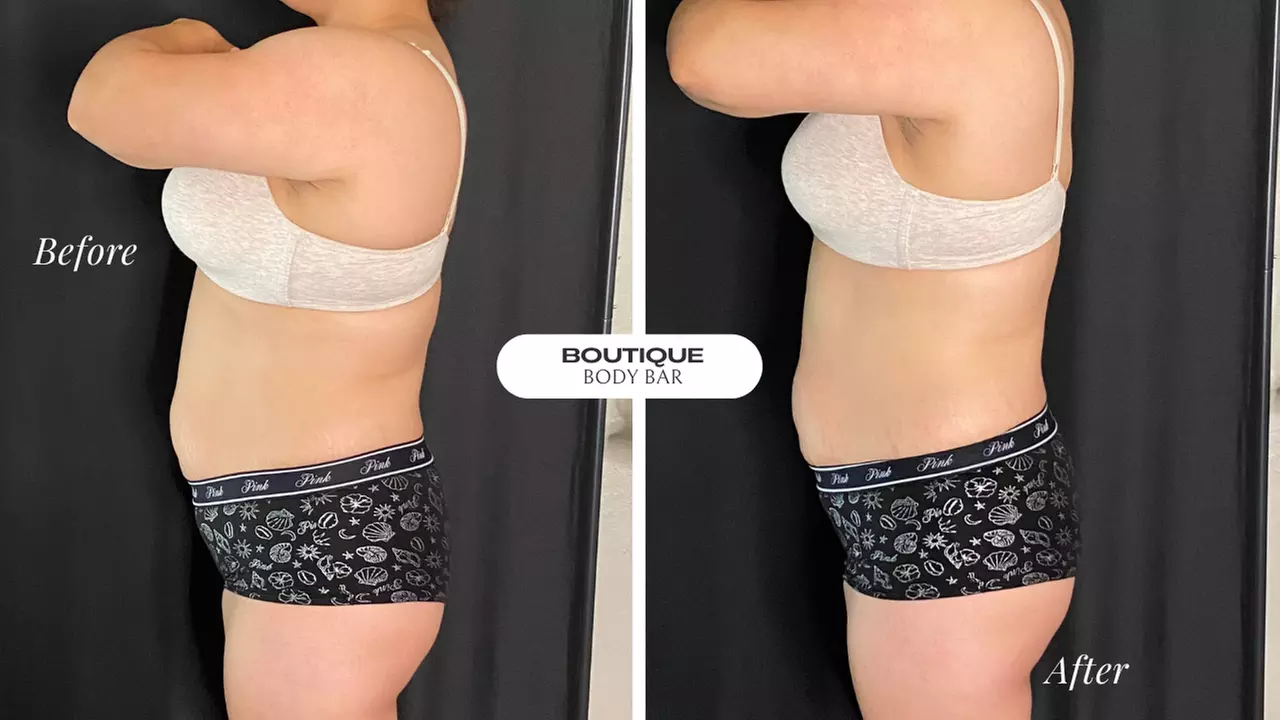 Transform Your Body: Ultrasonic Cavitation Session