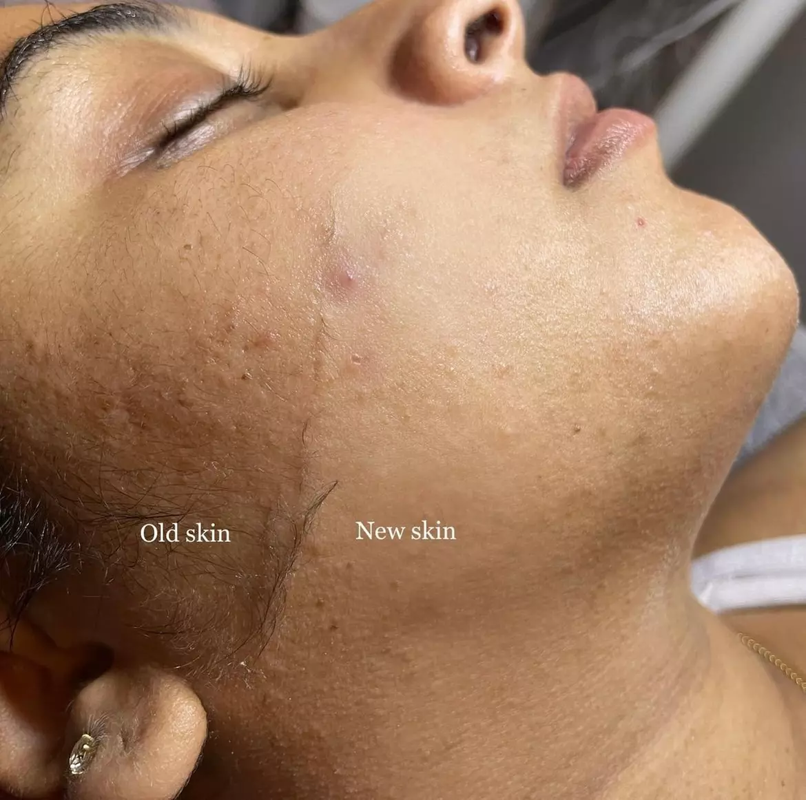 Up to 35% Off on HydraFacial at Beauty Works Galore - Primary Image