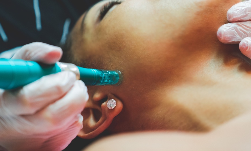 Image 1: Microneedling for Stretch Marks and Vampire Facial Options