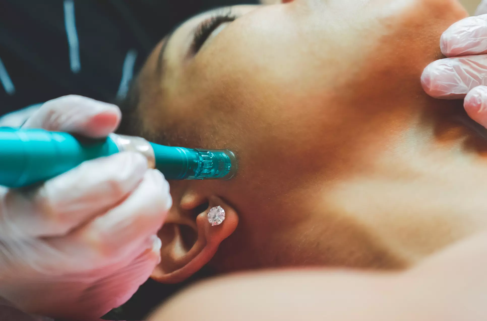 Explore Skin 2 Deep's microneedling for stretch marks or vampire facial options with up to 44% off, transforming your skin today - Primary Image