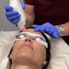 Image 5: Microneedling with Laser Resurfacing for the Hands, Lower Eyes, Neck, or Full Face at Loma Laser (Up to 47% Off)