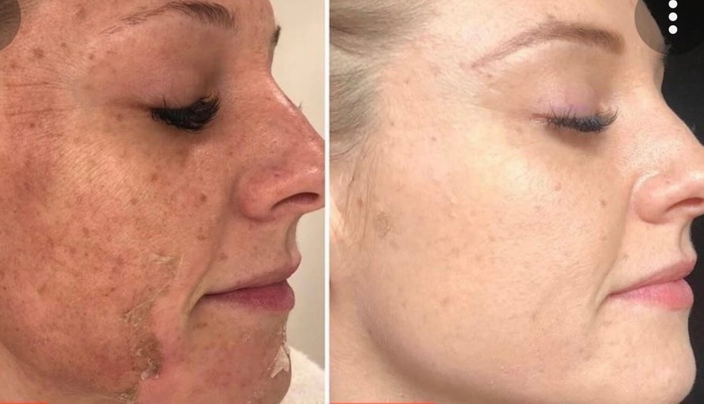 Facial and Dermaplaning with Hydrating Mask for Glowing Skin