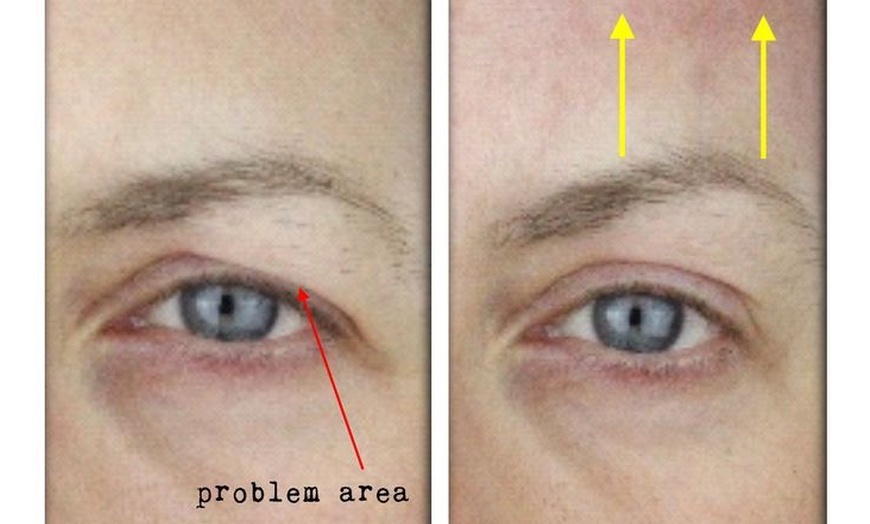 Image 8: Bella Hadid Style Eyebrow Lift With PDO Threads at No Pain All Gain Spa (Up to 30% Off)
