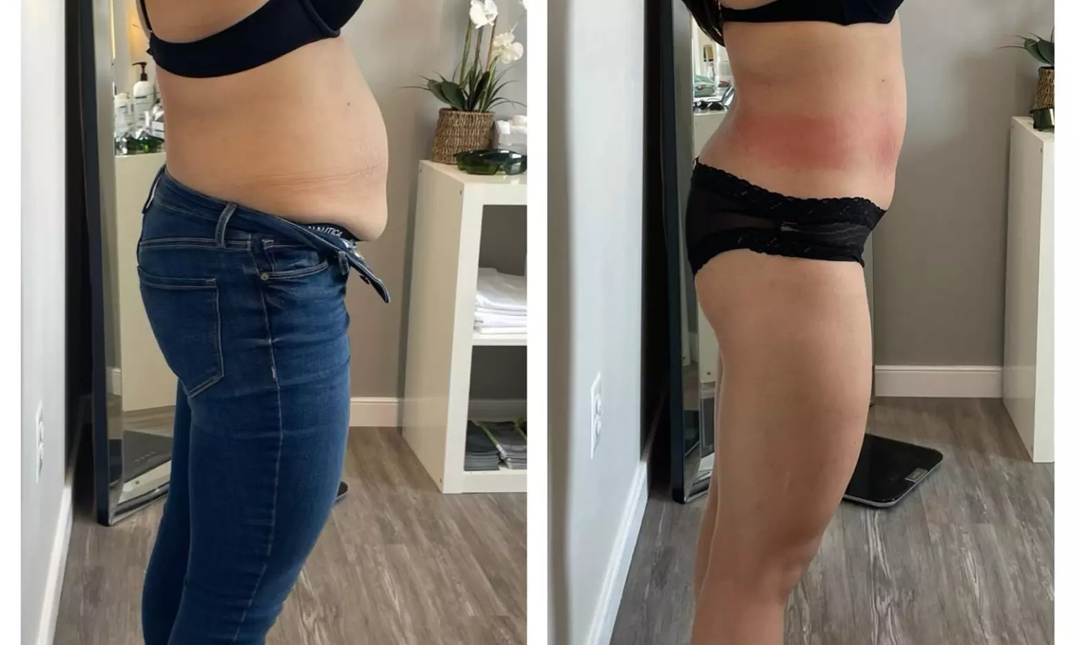 Radio Frequency Tightening for Face, Body & Abdomen — Upto 3 Sessions