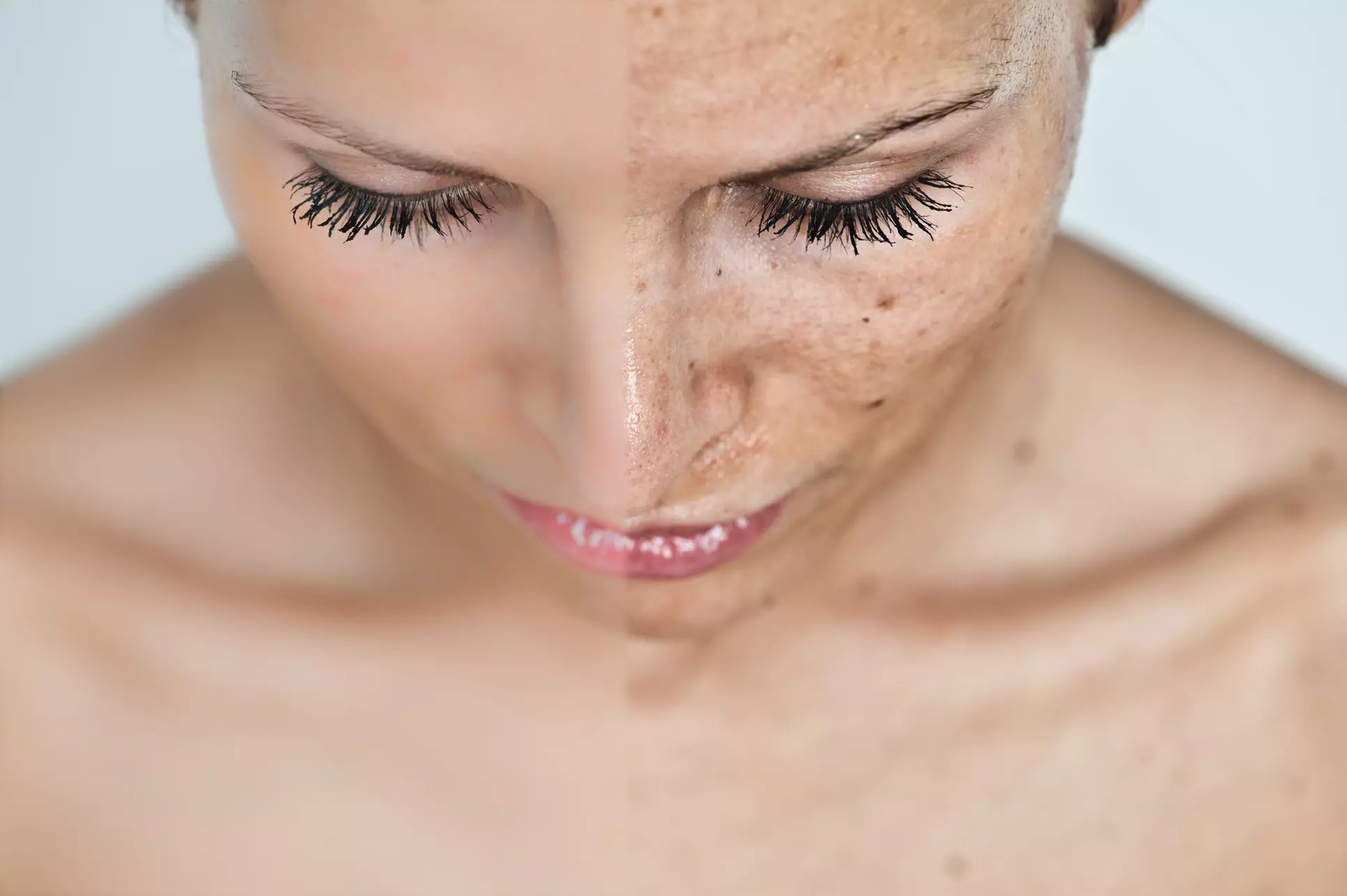 IPL Photofacial Treatment for Face and Neck