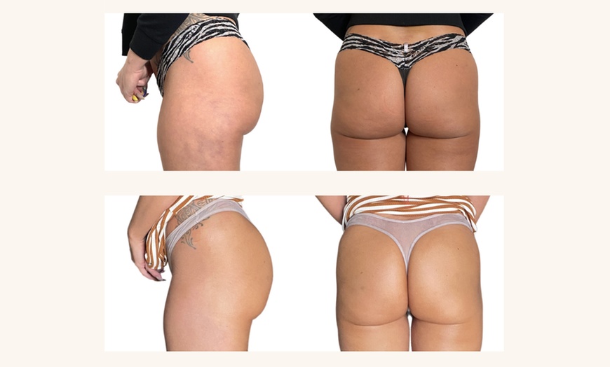Image 1: Up to 47% Off on Non-Surgical Butt Lift