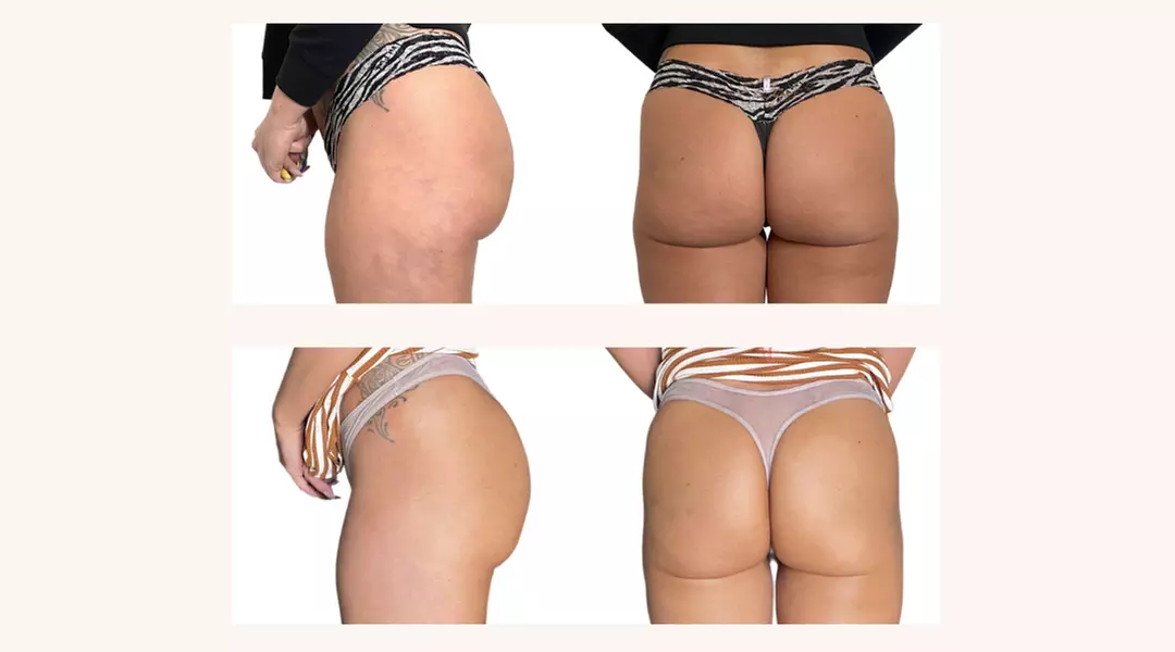 Non-Surgical Butt Lift at The Shape Shop Norterra (Up to 52% Off) - Primary Image