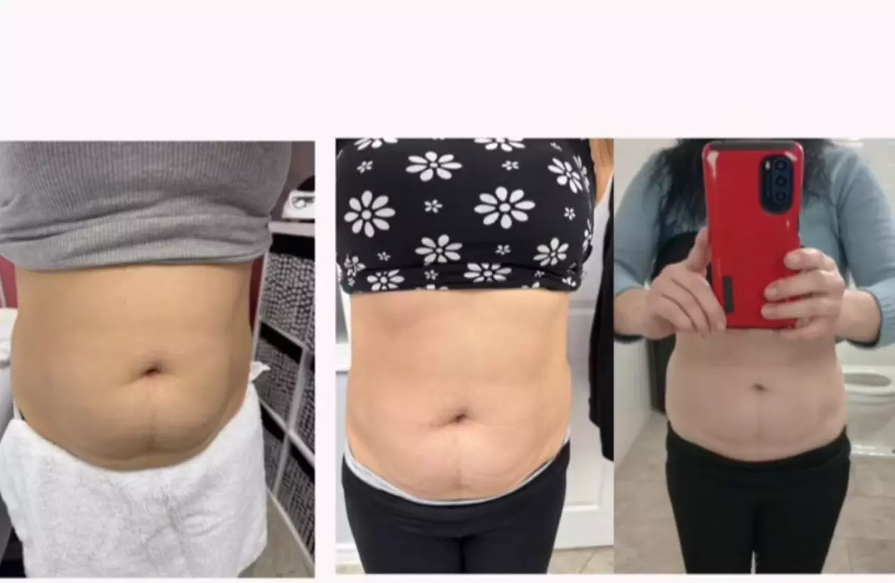 Tone with 1 or 2 Non Invasive Laser iLipo + Cavitation & Wood Therapy