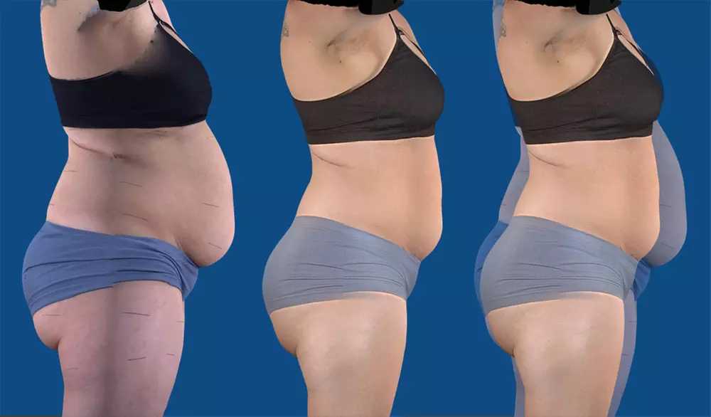 Up to 62% Off on Lipo - Non-Invasive Laser-iLipo at Medbed Spa Usa - Primary Image