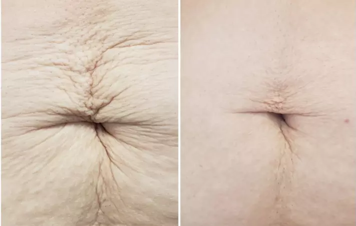 Get Youthful Skin with Fibroblast Treatments