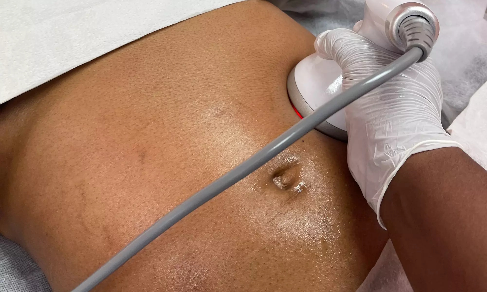 Radio frequency skin-tightening treatment options available
