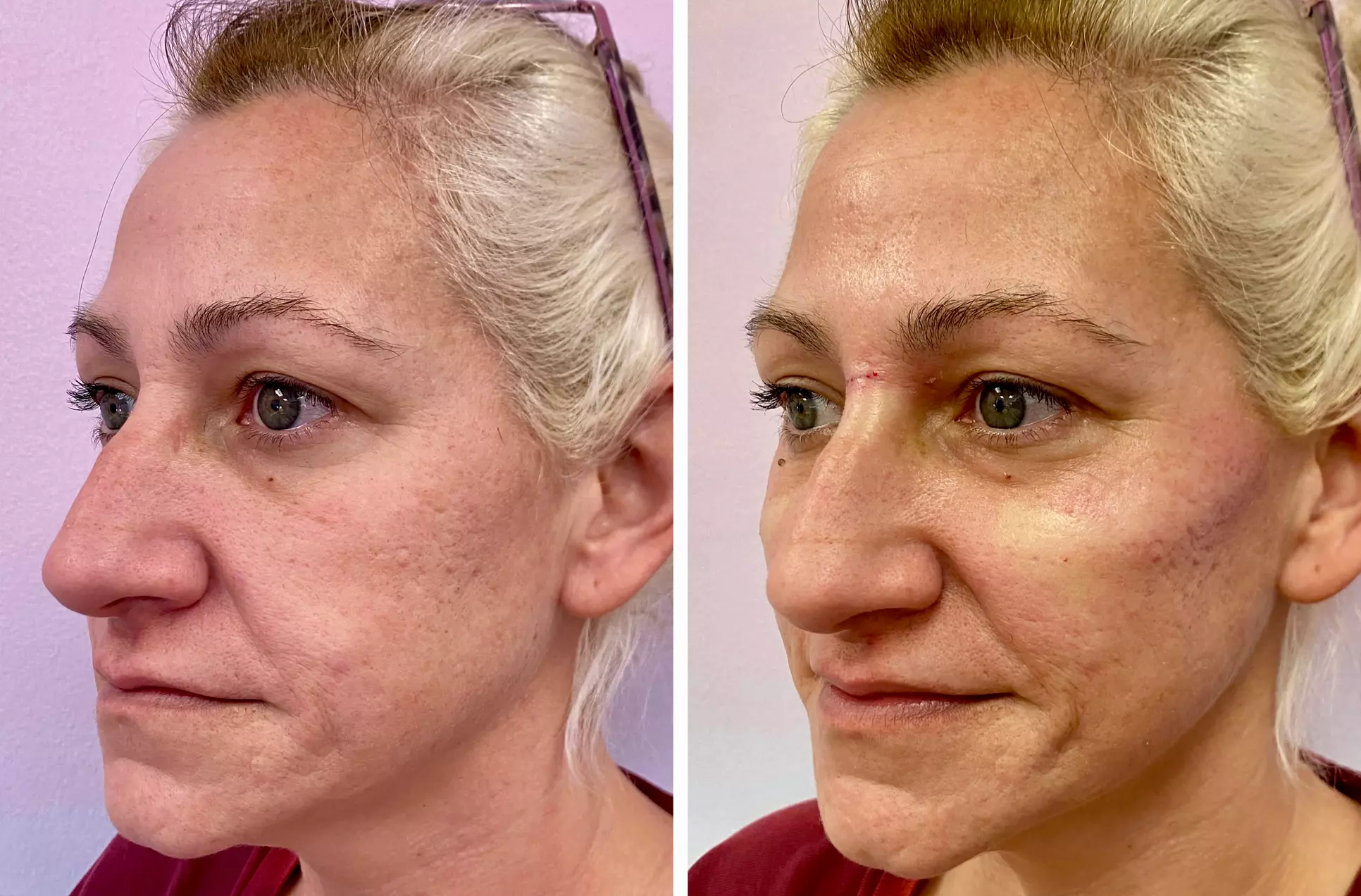 Up to 42% Off on Injection - Organic Filler at Artistic Touch Advanced Aesthetics - Primary Image