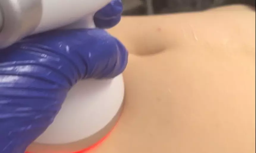 Up to 35% Off on Radio Frequency Skin Tightening at Qtpie Glam - Primary Image