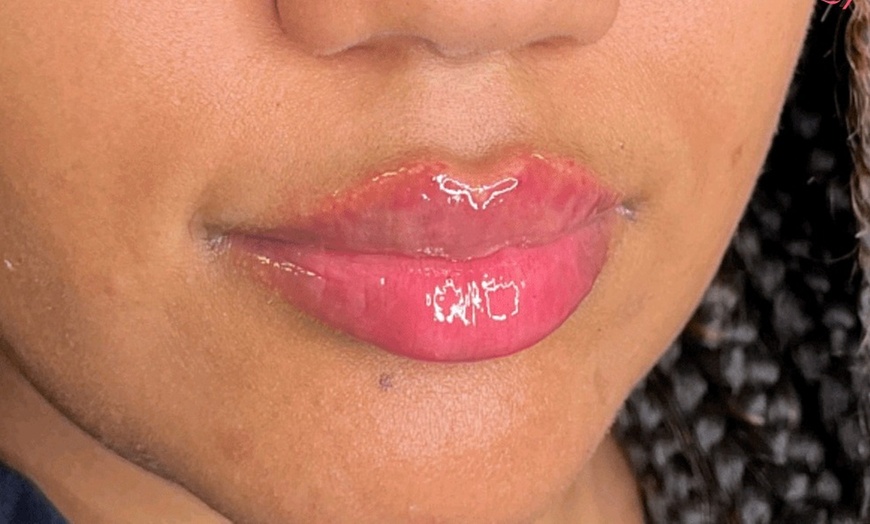 Image 2: Up to 36% Off on Injection - Hyaluronic Acid at Hilenda's Alluring Makeup