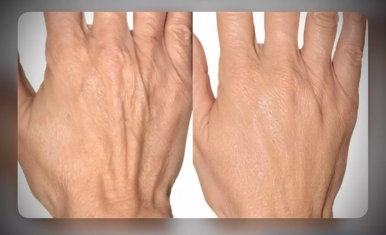 Odmładzająca pielęgnacja: RF lifting dłoni