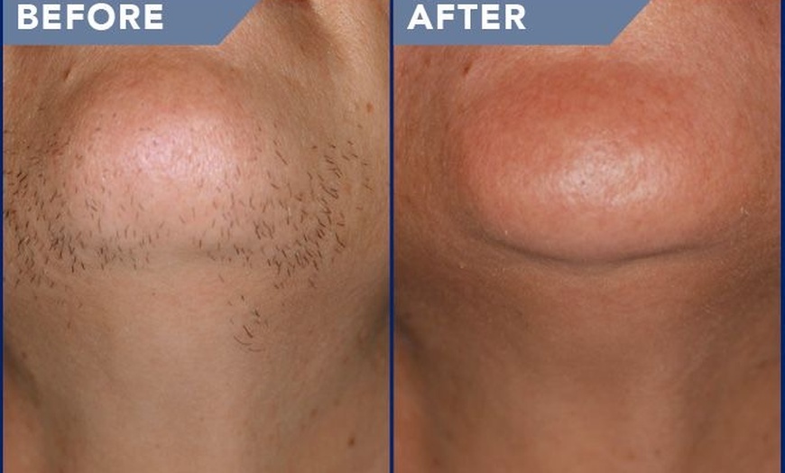 Image 4: Up to 87% Off on Laser Hair Removal at Aesthetics Care Med Spa