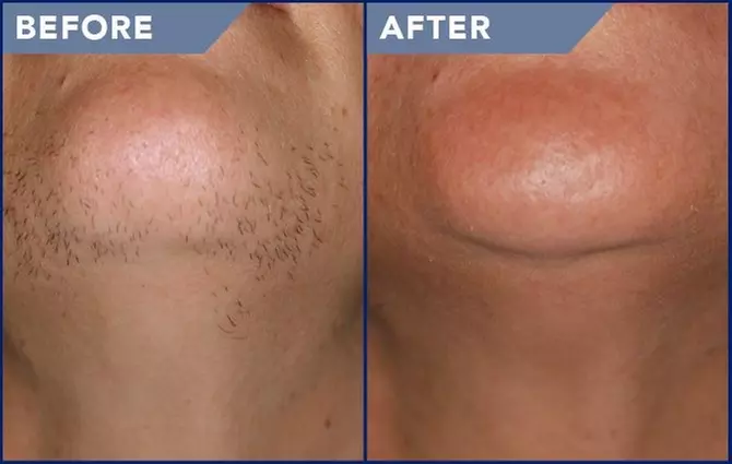 Up to 77% Off on Laser Hair Removal at Aesthetics Care Med Spa