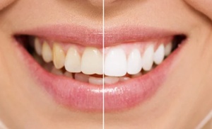 Teeth Whitening