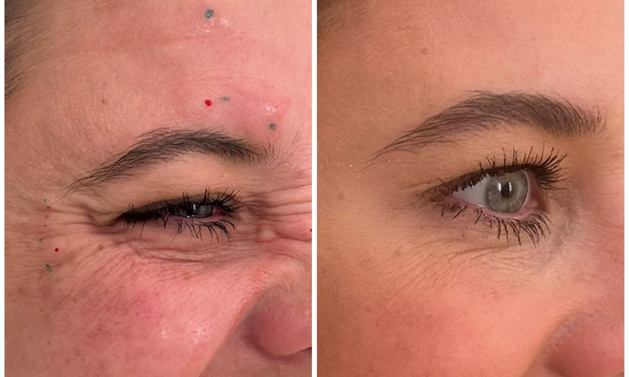 20, 40, or 60 Units of Letybo® Treatments for Smoother Skin