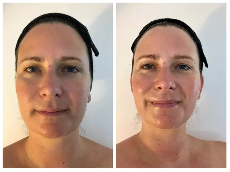 Up to 60% Off on Cryotherapy at UK Aesthetics Lounge