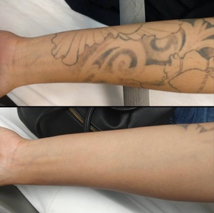 One Laser Tattoo Removal Session on a Small Area - Freedom Laser Hair Removal