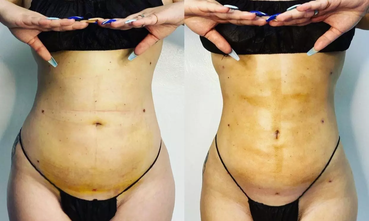 Up to 40% Off for Post-op Lymphatic Massage at Cali Bods 
