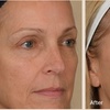 Image 5: Up to 90% Off on Facelift - Non-Surgical at The Body Edit