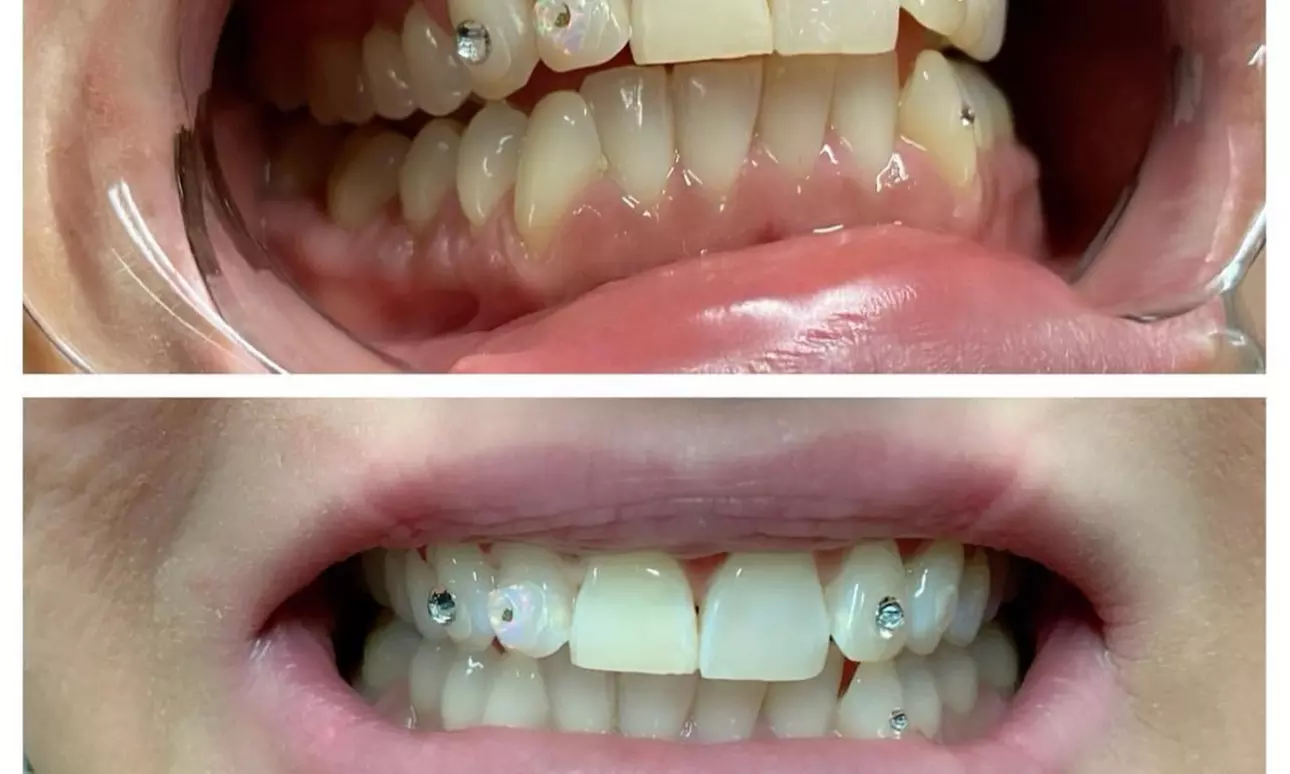Up to 50% Off on Teeth Whitening at White grill wasted - Second Medium
