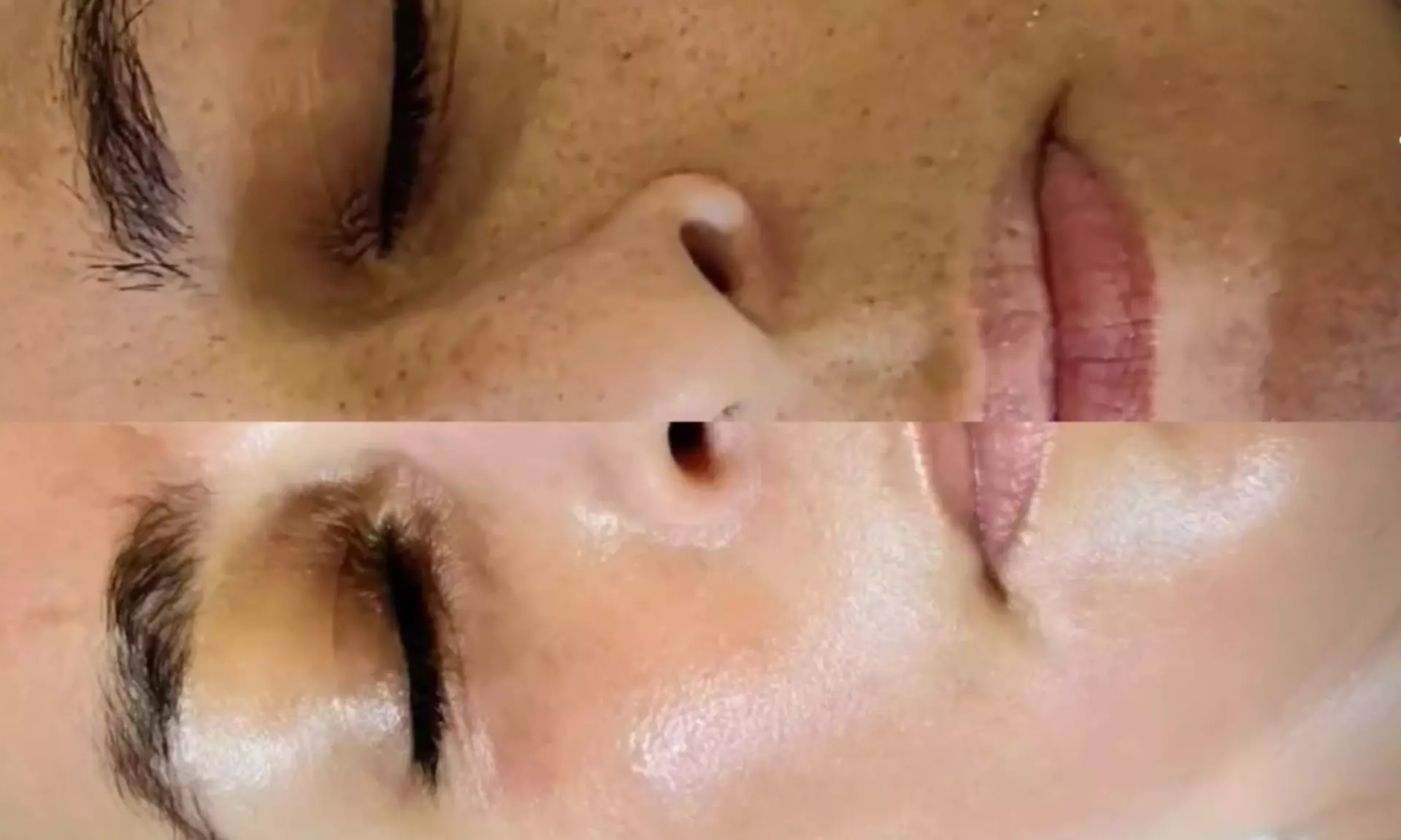 Experience the Ultimate Hydrafacial Package for Radiant Skin